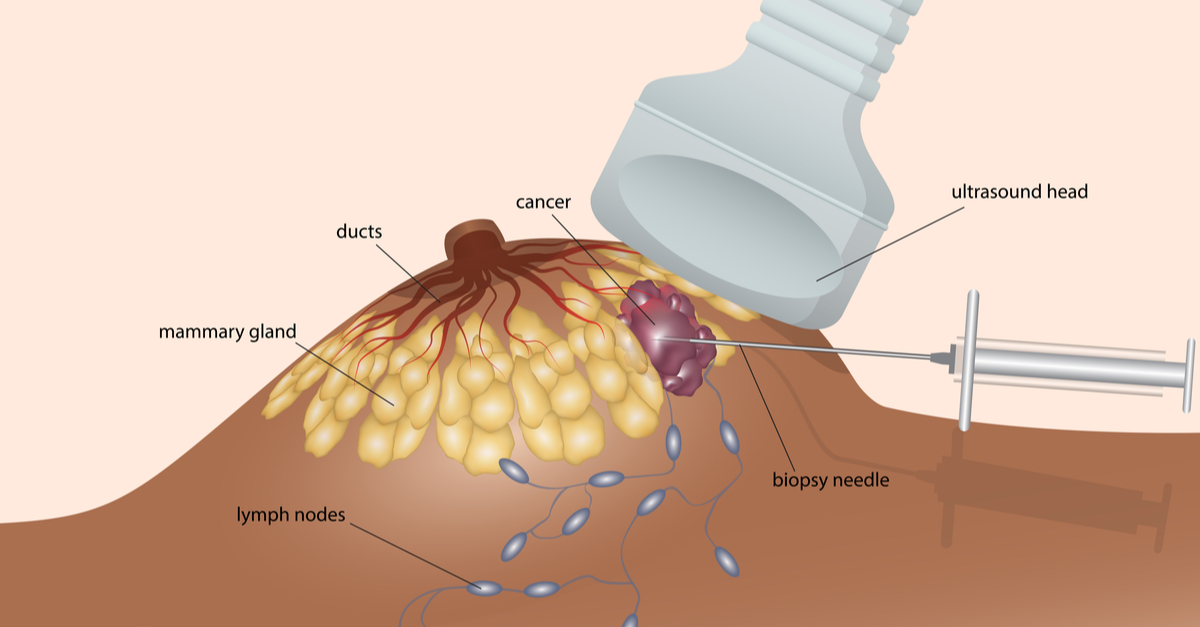 Biopsie mamara