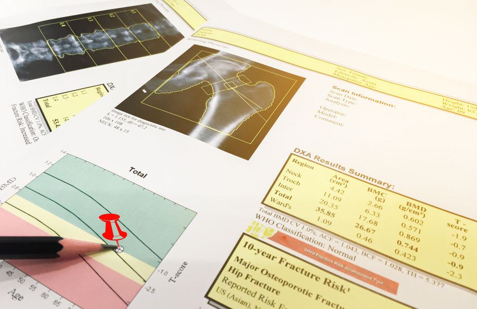 Osteodensitometrie (DEXA)